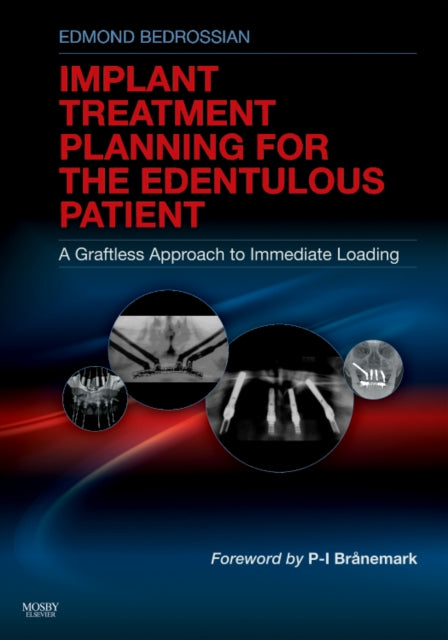 Book cover of: Implant Treatment Planning for the Edentulous Patient. By: Edmond Bedrossian