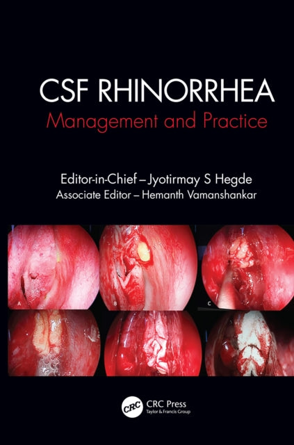 Book cover of: CSF Rhinorrhoea. By: Jyotirmay S. Hegde