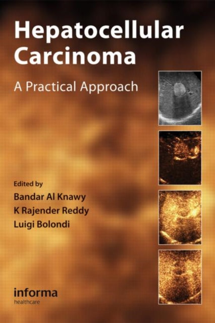 Book cover of: Hepatocellular Carcinoma. By: Bandar Al Knawy