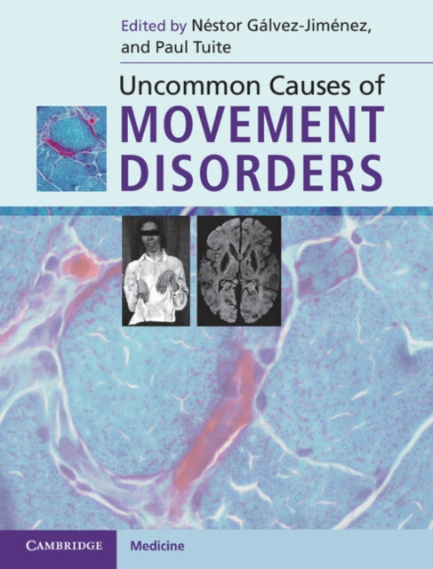 Book cover of: Uncommon Causes of Movement Disorders. By: Néstor Gálvez-Jiménez