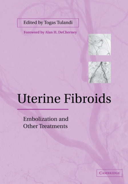 Book cover of: Uterine Fibroids. By: Togas Tulandi