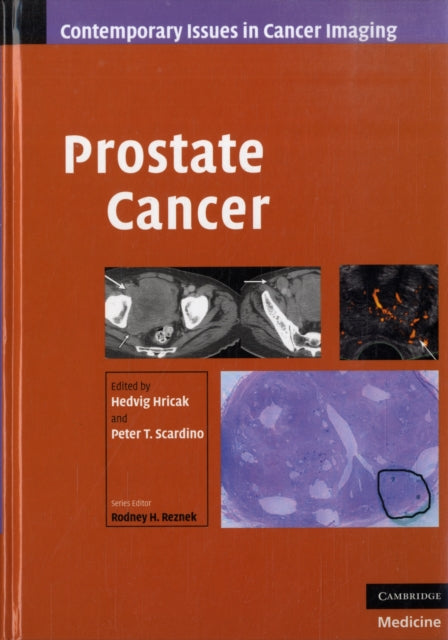 Book cover of: Prostate Cancer