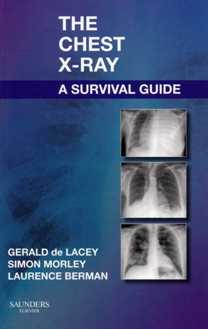 Book cover of: Chest X-Ray: A Survival Guide. By: Gerald de Lacey