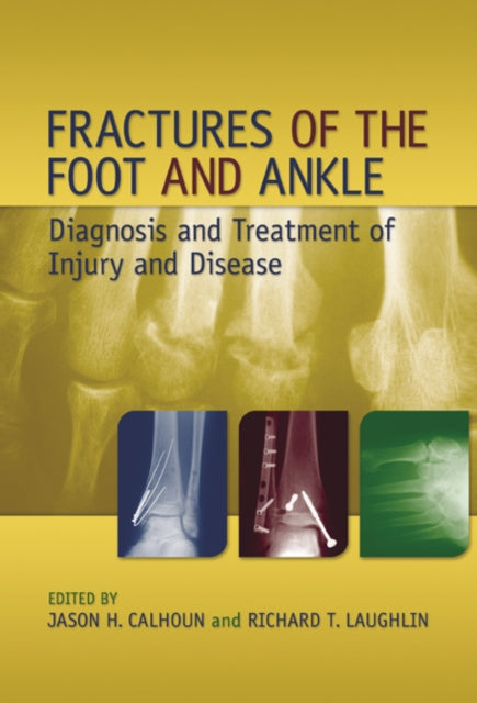 Book cover of: Fractures of the Foot and Ankle
