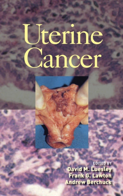 Book cover of: Uterine Cancer