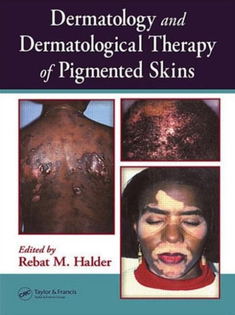 Book cover of: Dermatology and Dermatological Therapy of Pigmented Skins. By: Rebat Halder