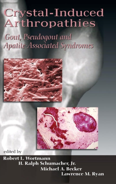 Book cover of: Crystal-Induced Arthropathies