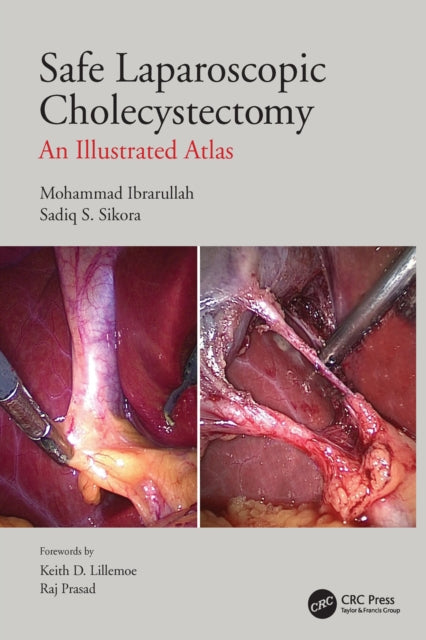 Book cover of: Safe Laparoscopic Cholecystectomy. By: Mohammad Ibrarullah