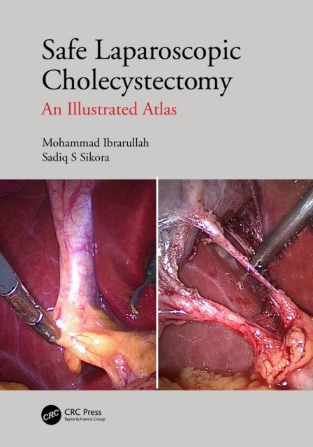 Book cover of: Safe Laparoscopic Cholecystectomy. By: Mohammad Ibrarullah