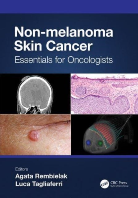 Book cover of: Non-melanoma Skin Cancer. By: Agata Rembielak