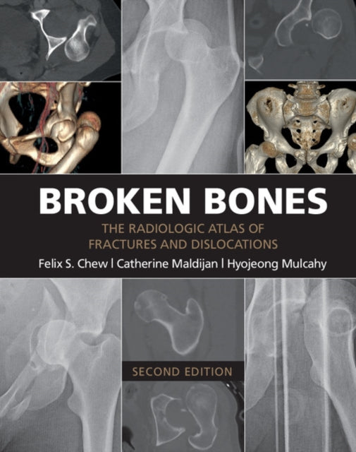 Book cover of: Broken Bones. By: Felix S. Chew