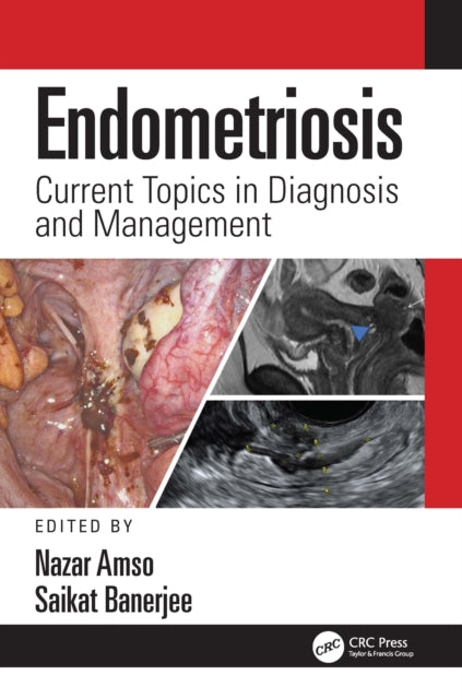 Book cover of: Endometriosis. By: Nazar N. Amso
