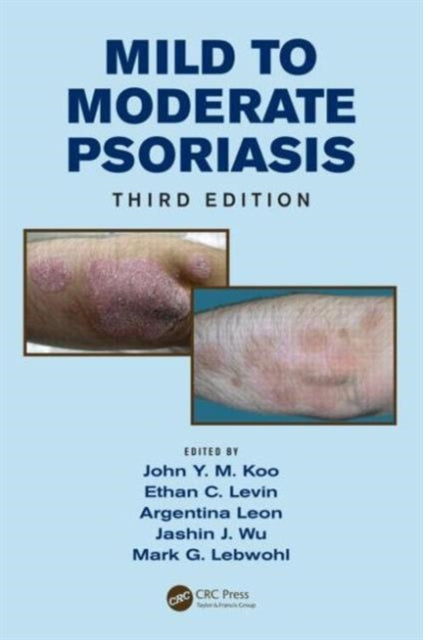 Book cover of: Mild to Moderate Psoriasis. By: John Y. M. Koo