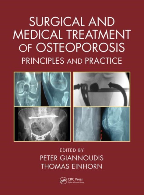 Book cover of: Surgical and Medical Treatment of Osteoporosis. By: Peter V. Giannoudis
