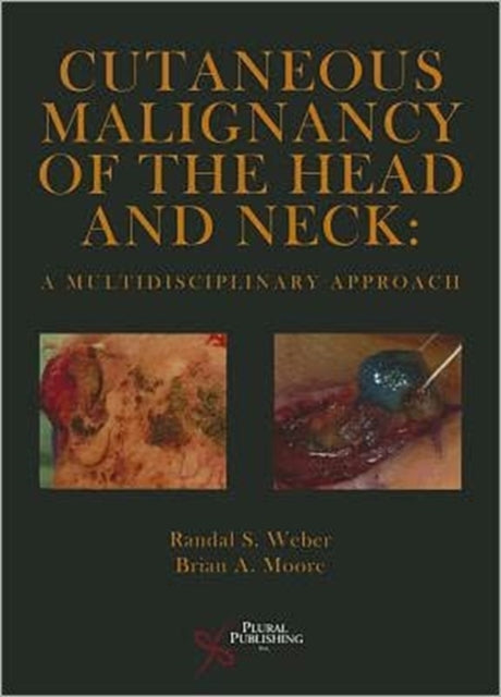 Book cover of: Cutaneous Malignancy of the Head and Neck. By: Randal S. Weber