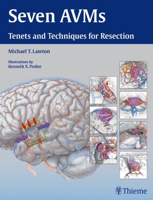 Book cover of: Seven AVMs. By: Michael T. Lawton