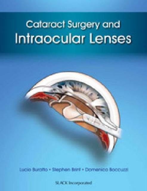Book cover of: Cataract Surgery and Intraocular Lenses. By: Lucio Buratto MD
