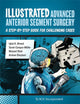 Book cover of: Illustrated Advanced Anterior Segment Surgery. By: Iqbal K. Ahmed