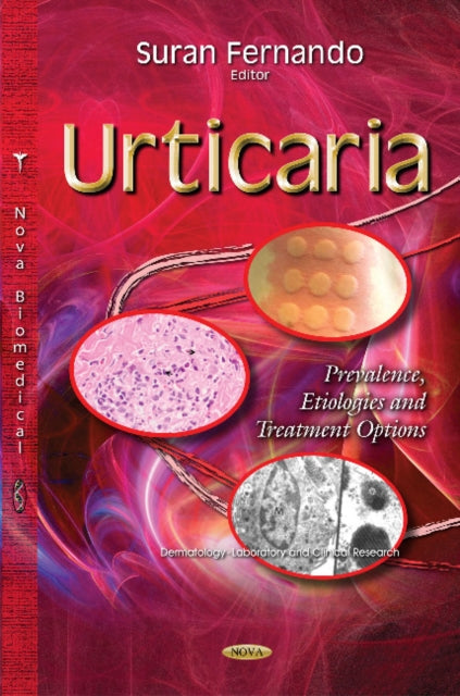 Book cover of: Urticaria. By: Suran Fernando