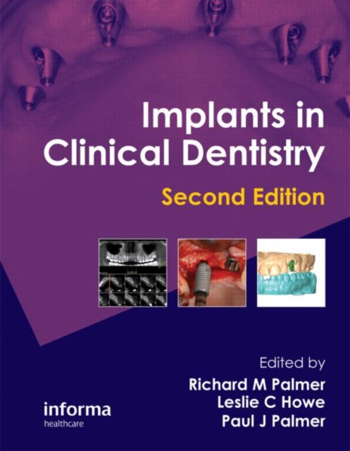 Book cover of: Implants in Clinical Dentistry. By: R. Palmer