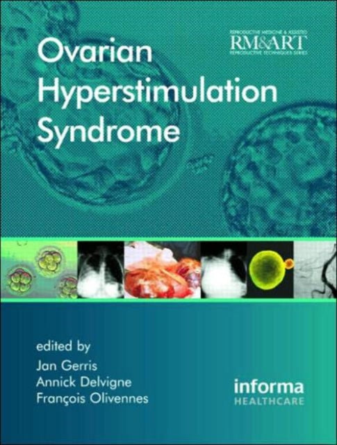 Book cover of: Ovarian Hyperstimulation Syndrome