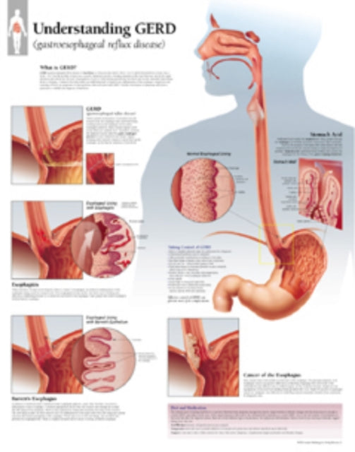 Book cover of: Understanding GERD (Gastroesophageal Reflux Disease) Paper Poster. By: Scientific Publishing