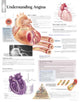 Book cover of: Understanding Angina Laminated Poster. By: Scientific Publishing