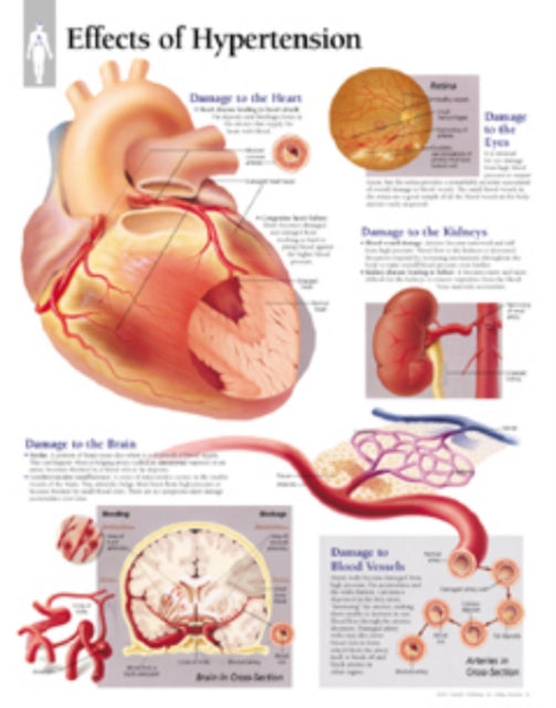 Book cover of: Effects of Hypertension Laminated Poster. By: Scientific Publishing