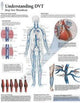 Book cover of: Understanding DVT Laminated Poster