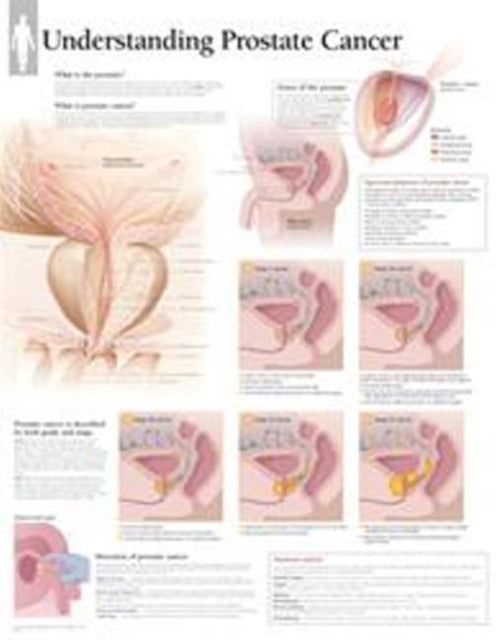 Book cover of: Understanding Prostate Cancer Paper Poster