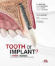 Book cover of: Tooth or Implant. By: Pio Bertani