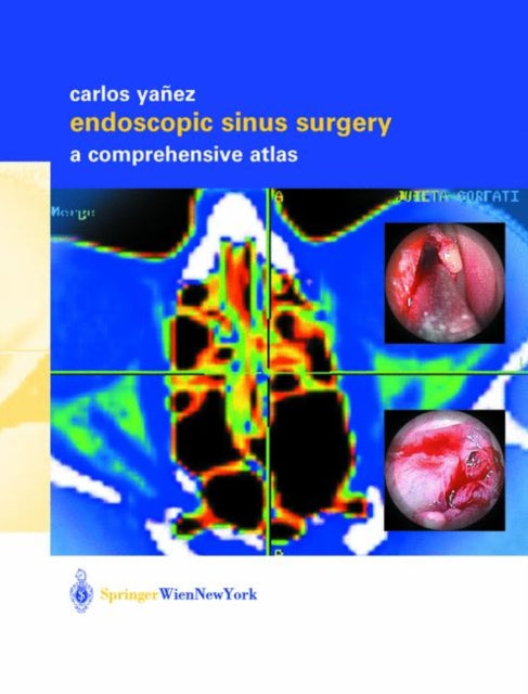 Book cover of: Endoscopic Sinus Surgery. By: Carlos Yañez