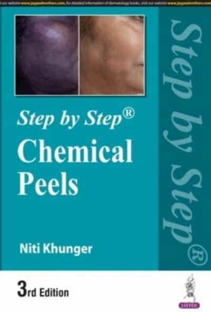 Book cover of: Step by Step: Chemical Peels
